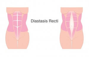 Diastasis-Recti-Abdominis-Burrell